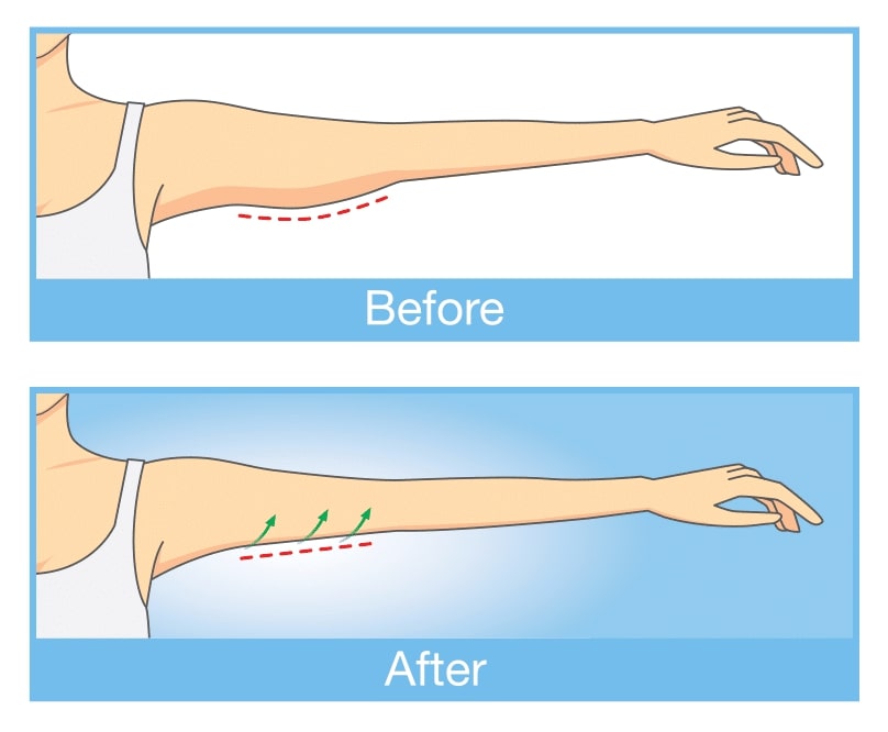 Arm Lift Recovery - What to Expect - Gaines Plastic Surgery