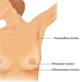 Best breast implant incision