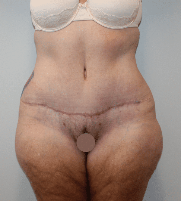 Awake Office Mons Liposuction & BodyTite (Scarless Monsplasty