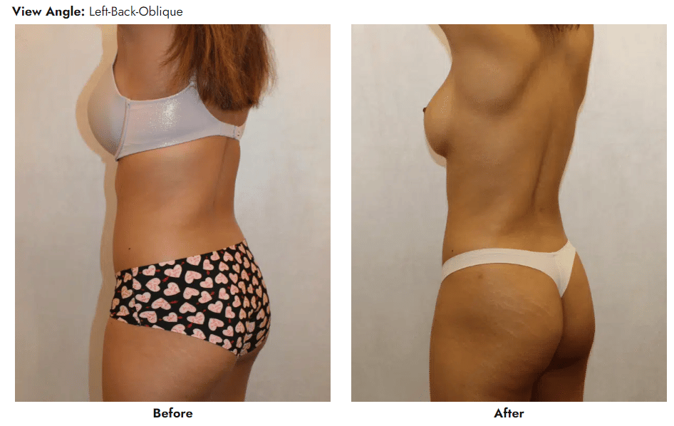 Liposuction, Body Contouring