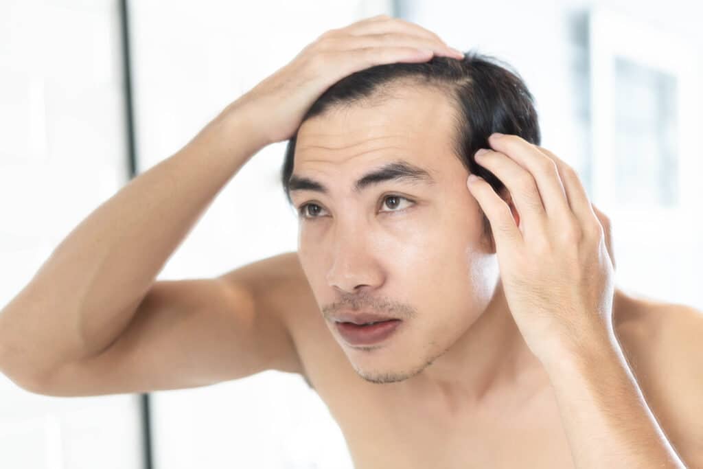 A man looking in the mirror at his hairline after hair transplant surgery