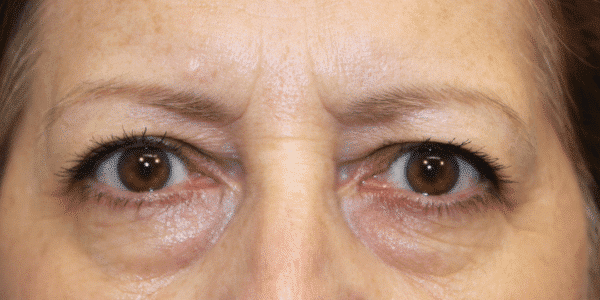 1766078276_Eye-Lift-Blepharoplasty-c1-b1 Brow Lift in Gainesville, FL
