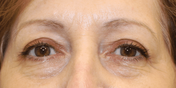 1766078280_Eye-Lift-Blepharoplasty-c1-a1 Brow Lift in Gainesville, FL
