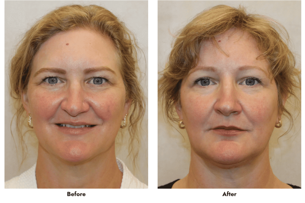 1766080722_Screen-Shot-2022-11-11-at-3.15.44-PM Brow Lift in Gainesville, FL